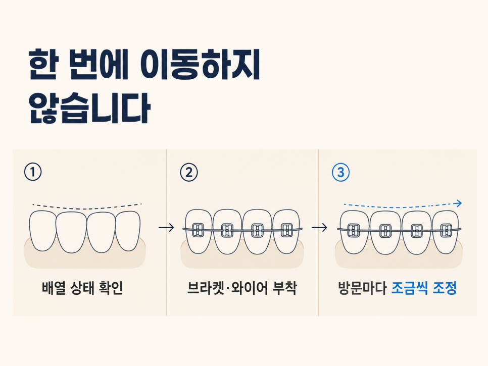 The Orthodontic Process: Do Teeth Start Moving Immediately After Brackets Are Attached? image 4