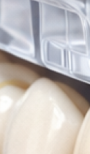 40대 치아 교정 고민 중이라면? 부담 줄이고 효율 높이는 선택법 관련 이미지 35