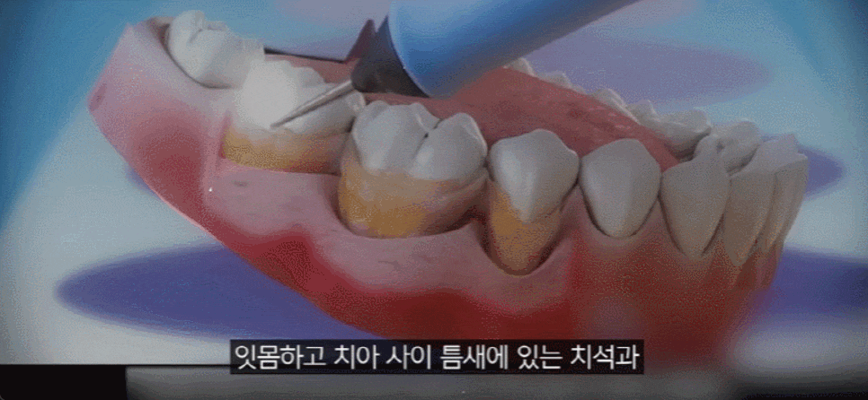 잇몸 염증 원인과 치료법 (치은염, 치주염 전격 분석) 관련 이미지 5