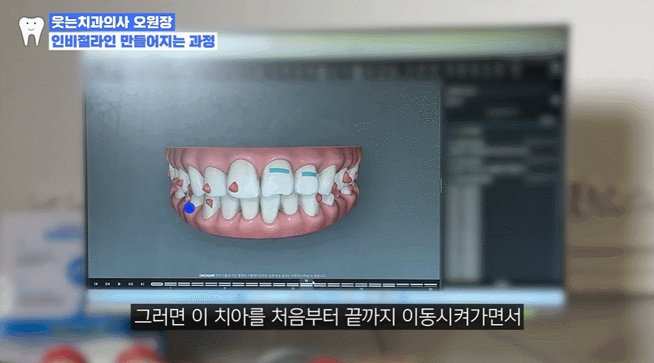 인비절라인기간과 인비절라인 통증, 교정 효과는? 관련 이미지 5