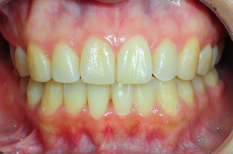 10대 vs 30대 비발치 교정, 얼굴형 변화가 다를 수밖에 없는 이유 관련 이미지 5