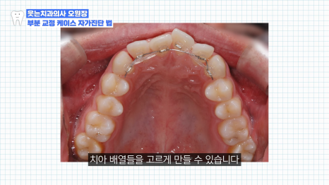 Front Tooth Laminate? Front Tooth Partial Orthodontics? How to Choose Without Regret image 15