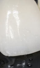 신사역 라미네이트 치과, 자연스러운 미소를 결정짓는 비밀 관련 이미지 38