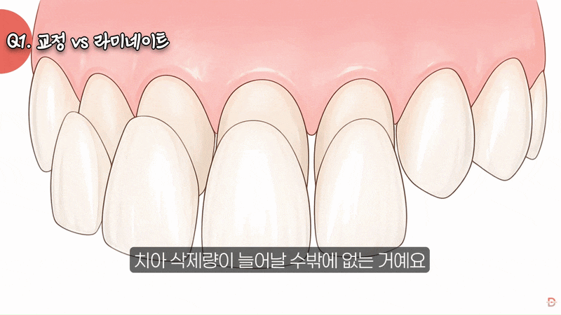 라미네이트 부작용, 이것도 모르고 시작하면 후회합니다 관련 이미지 4