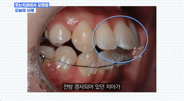 교정했는데 "합죽이입매" 됐다면? 옥니교정 골든타임, 더 늦기 전에 관련 이미지 4