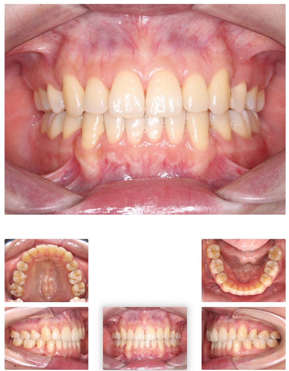 Gap Between the Front Teeth? Don’t Judge It by Front Teeth Partial Orthodontic Reviews Alone image 10