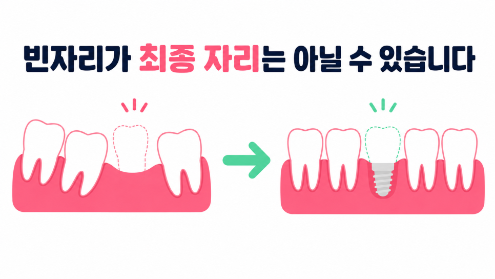 교정 중 임플란트, 치료 순서는 어떻게 정해야 할까요? 관련 이미지 6