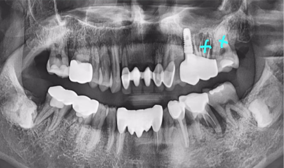 임플란트수술, 당일임플란트로 빠르게 끝내고 싶으신가요? 관련 이미지 9