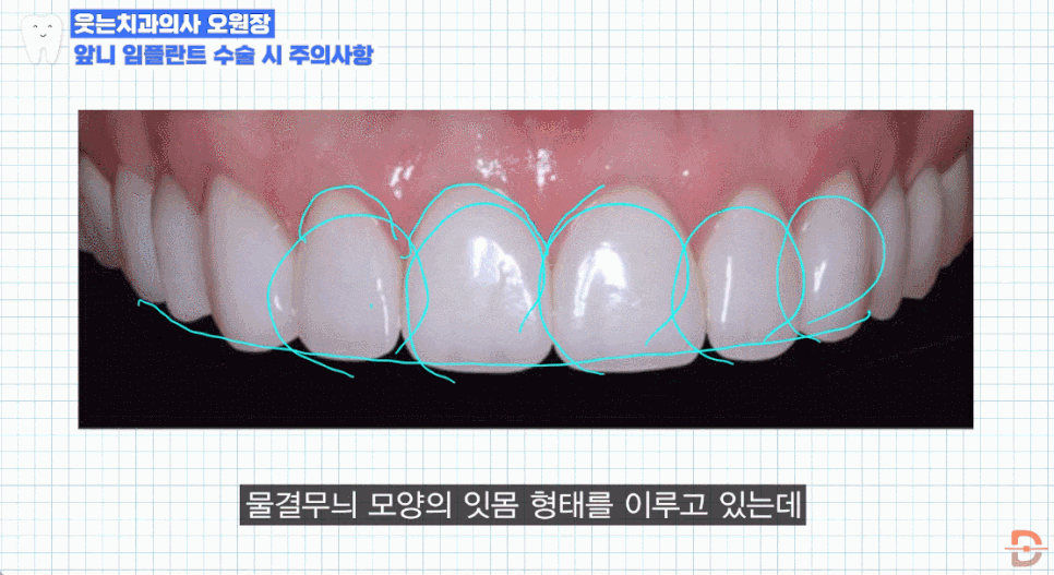 앞니임플란트치과 찾기 전 제발 이 글부터 읽어보세요 관련 이미지 14