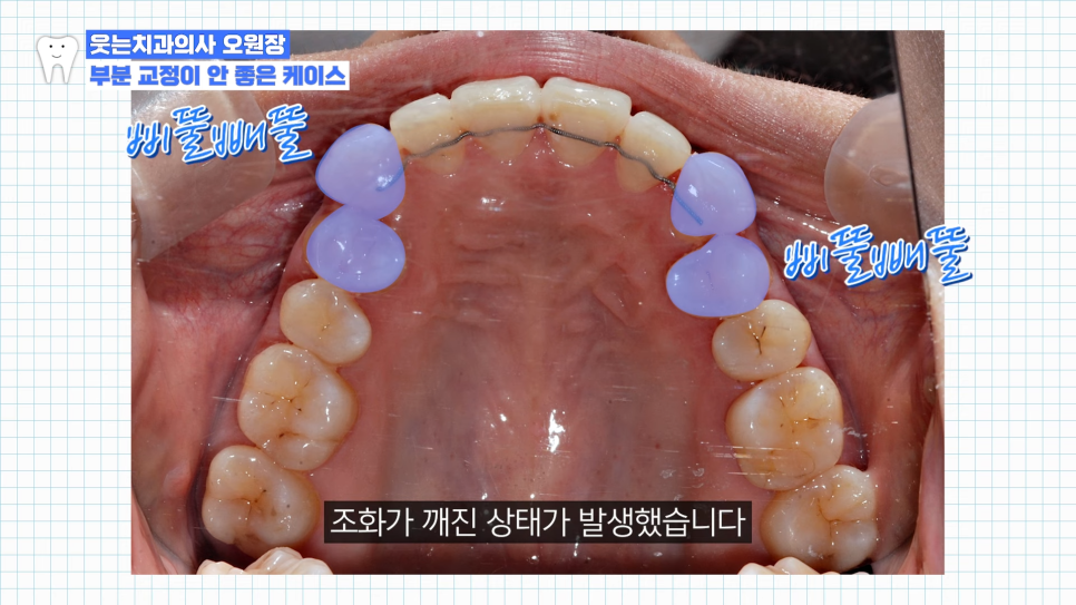 부분교정하고 이렇게 변했습니다 교정 전후 비교 관련 이미지 15