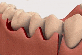 잇몸 염증 원인과 치료법 (치은염, 치주염 전격 분석) 관련 이미지 6