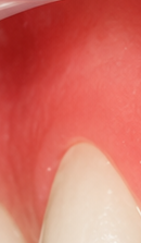 What to Check When Considering No-Prep Laminate Veneers in Gangnam image 29