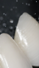 신사역 라미네이트 치과, 자연스러운 미소를 결정짓는 비밀 관련 이미지 31