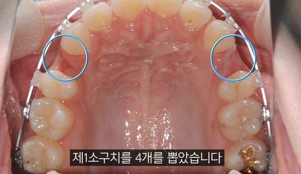 성인 부정교합 교정? 이런 분들은 사실 안 받아도 됩니다 관련 이미지 4