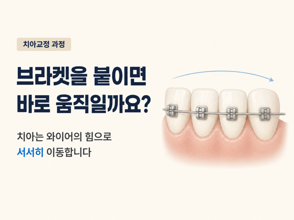 The Orthodontic Process: Do Teeth Start Moving Immediately After Brackets Are Attached? image 1