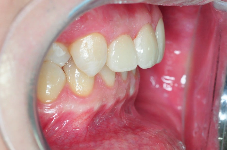 When You Fact-Check the Cost of Laminates and Before-and-After Laminates image 5