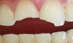 앞니살짝깨짐 빠르게 복원하는 방법 (레진, 라미네이트, 크라운) 관련 이미지 4