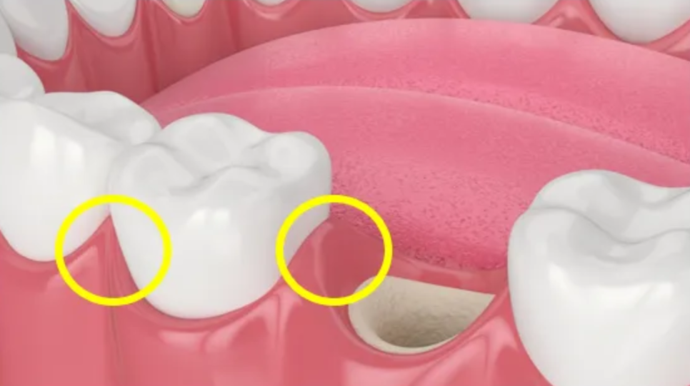 Dental contouring? This is how it changes with rabbit teeth laminate image 6