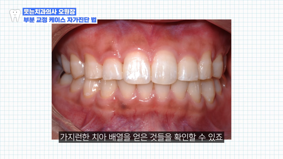 부분교정하고 이렇게 변했습니다 교정 전후 비교 관련 이미지 11