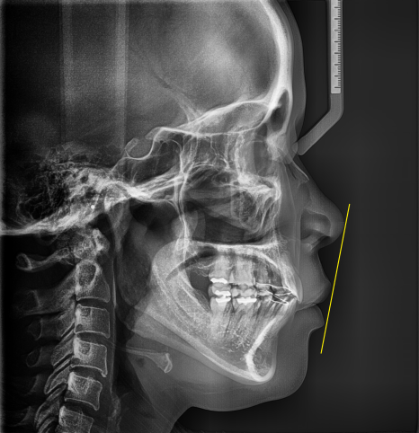 Protruding Mouth Correction and Underbite Correction: A Case Improved Without Surgery image 7