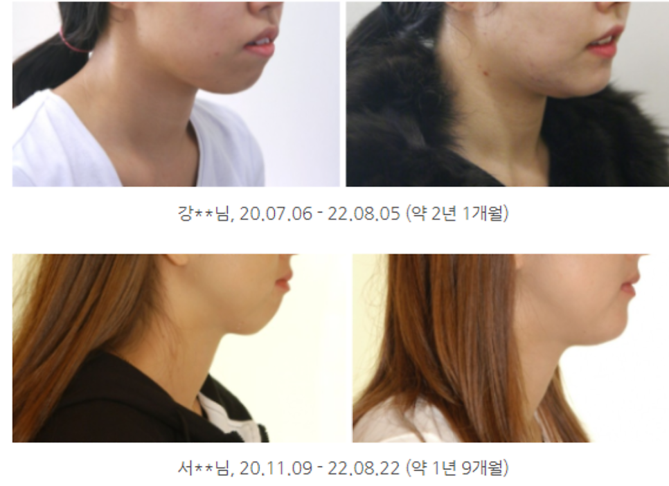 무턱교정전후, 얼굴 라인 어떻게 달라지는지 <공개> 관련 이미지 5