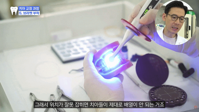 The Orthodontic Process: Do Teeth Start Moving Immediately After Brackets Are Attached? image 6