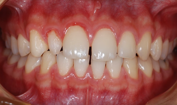 How to Fix Gaps in the Front Teeth with Clear Aligners (Clear Aligner Price) image 6