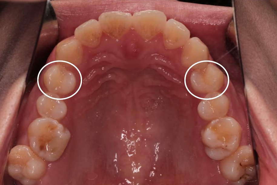 돌출입수술 대신, 인비절라인 돌출입 개선 사례 관련 이미지 11