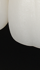 앞니 벌어짐 치료 전 반드시 체크해야 할 것들 정리 관련 이미지 37