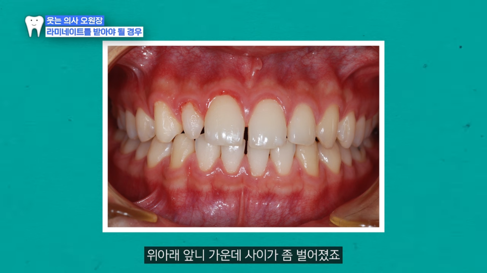 Gap Between the Front Teeth? Don’t Judge It by Front Teeth Partial Orthodontic Reviews Alone image 2