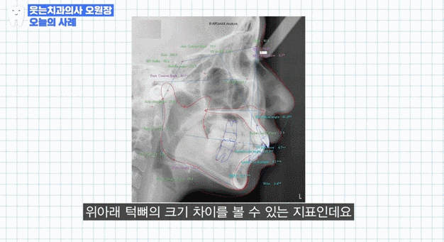 무턱교정 전후, 얼굴라인 달라지고 싶다면 관련 이미지 13