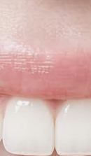 서울라미네이트치과 알아보고 있다면 관련 이미지 29