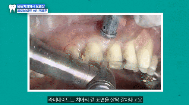 앞니 라미네이트 가격 00만 원? 진짜 중요한 건 따로 있어요 관련 이미지 3