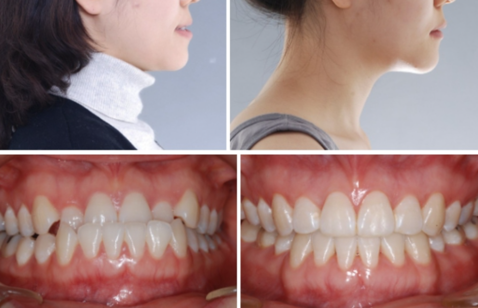 Can Non-Surgical Underbite Correction Really Be Done Without Surgery? Orthodontic Clinic Recommendation image 3