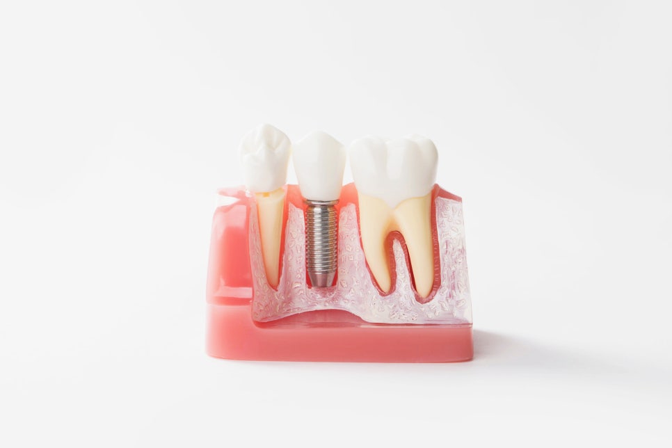 보험임플란트 관련 자주 듣는 질문 전문의가 답변드립니다 관련 이미지 10