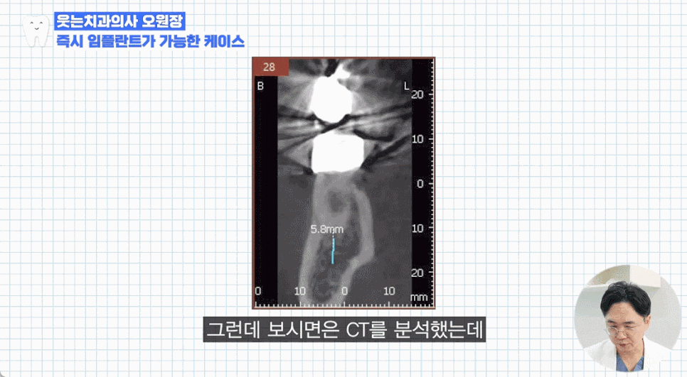 임플란트수술, 당일임플란트로 빠르게 끝내고 싶으신가요? 관련 이미지 7