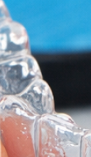 성인 돌출입 교정, 발치 없이도 변화가 가능할까? 관련 이미지 41