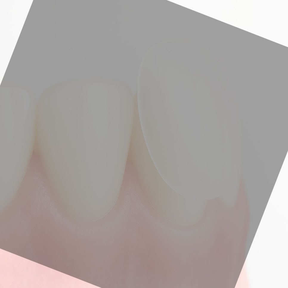 무삭제 라미네이트 후기 꼼꼼히 찾아봤어요 관련 이미지 10