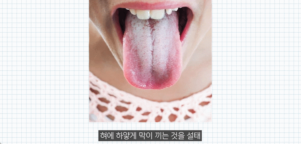 Types and Causes of Bad Breath, and How to Resolve It <Must-Read If Your Breath Smells Terrible> image 3