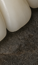 Systematic Examination Process to Review Before Deciding on Front Teeth Laminates image 42