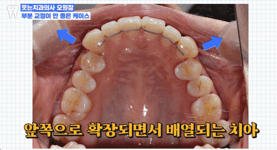나비 앞니 교정 관련 이미지 4