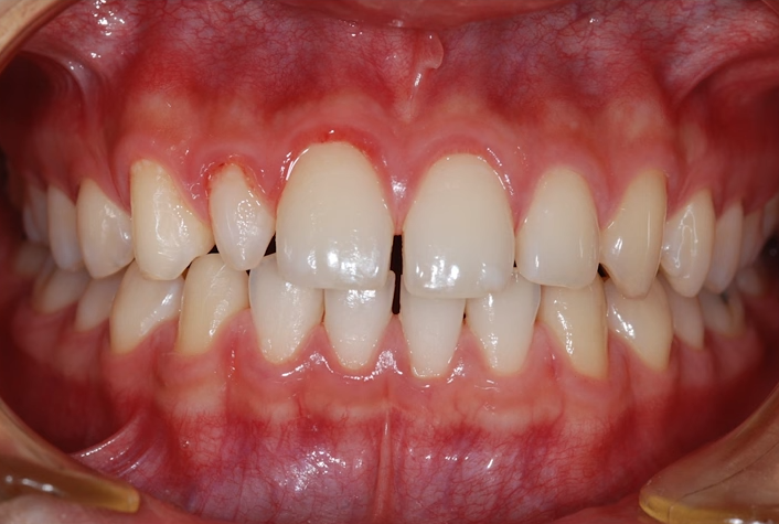 Front teeth gaps? Here are 3 solutions after adult orthodontic treatment image 6
