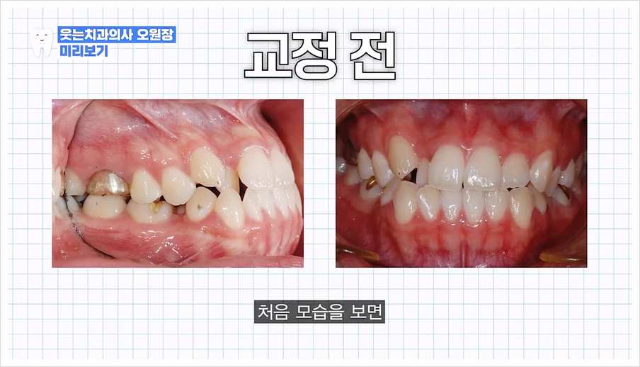 주걱턱 교정 VS 양악수술? 교정과 전문의가 답변드립니다 관련 이미지 19