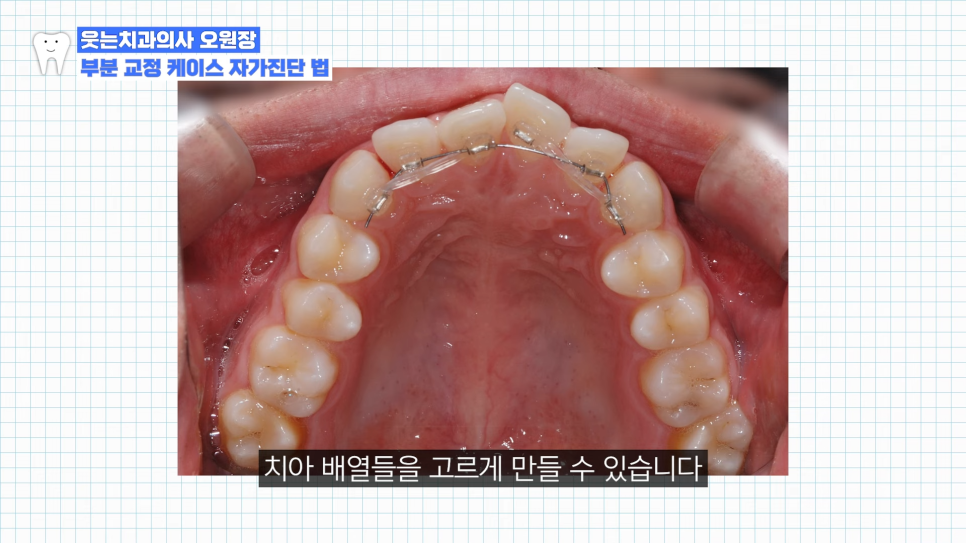 토끼 이빨 교정, 토끼 앞니 부분교정으로 가능할까? 관련 이미지 4
