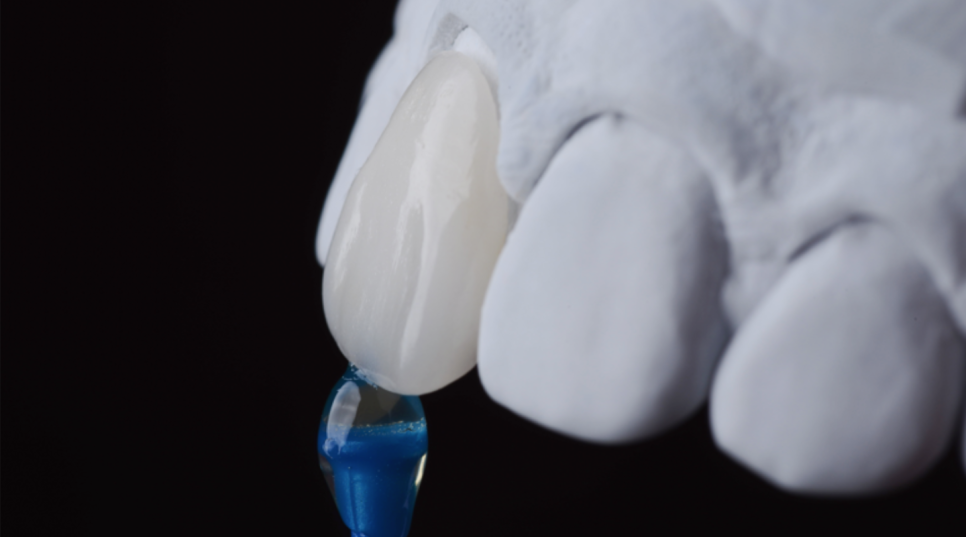 A Case of Failed Dental Laminates After Focusing Only on the Cost of Laminates image 11