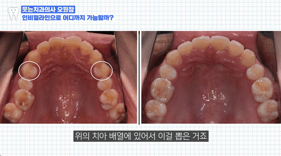 인비절라인기간과 인비절라인 통증, 교정 효과는? 관련 이미지 2