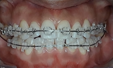 덧니교정 비발치로도 가능할까? 관련 이미지 3
