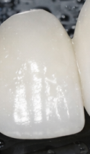 신사역 라미네이트 치과, 자연스러운 미소를 결정짓는 비밀 관련 이미지 37