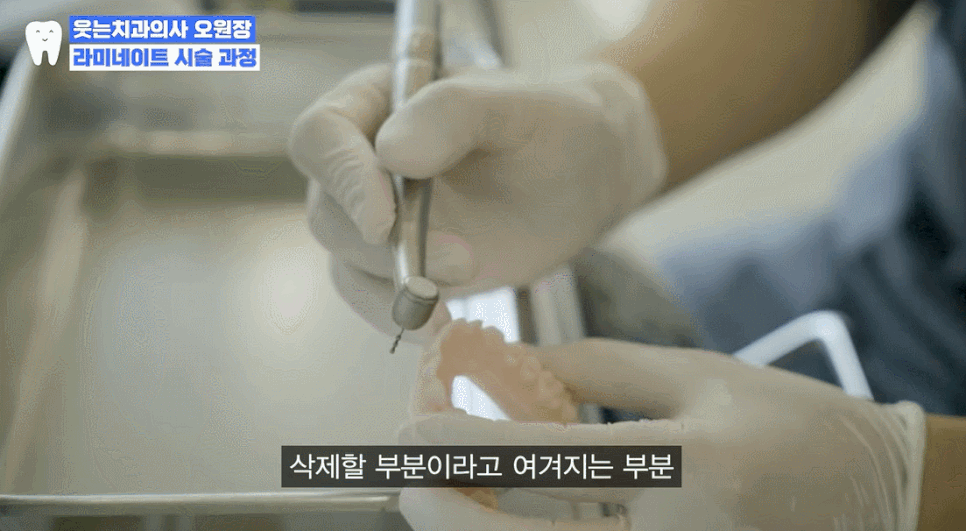 덧니 라미네이트와 덧니 교정, 뭐가 더 나을까요? < 18년차 전문의 답변> 관련 이미지 3