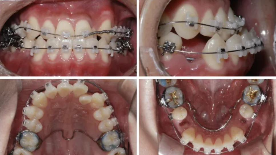 Protruding Mouth Correction and Underbite Correction: A Case Improved Without Surgery image 9